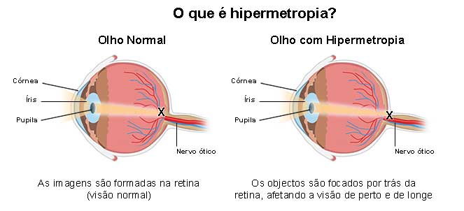 o olho com hipermetropia