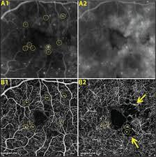 OCT angio - dra denise leite