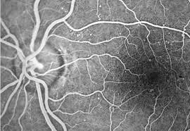 retinografia fluorescente - dra denise leite