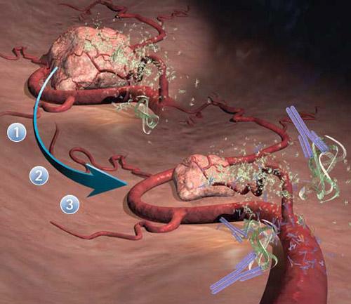 tratamento da retinopatia diabética